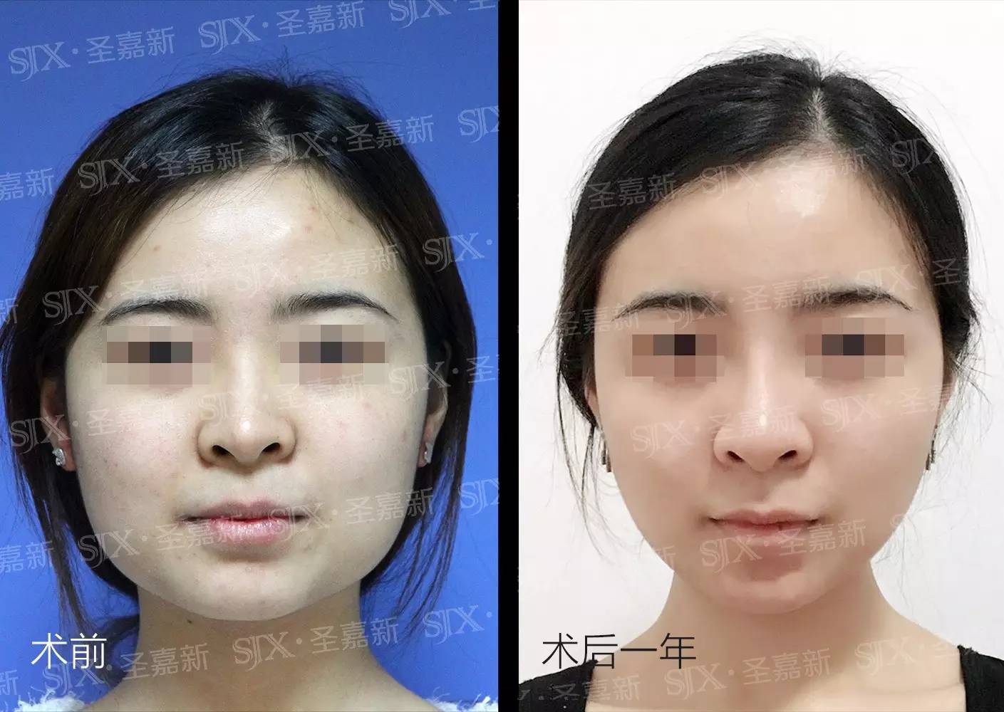 拔智齿可以瘦脸吗?科普!