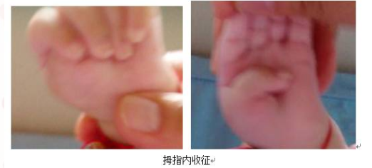 不是所有的拇指内扣就是脑瘫儿