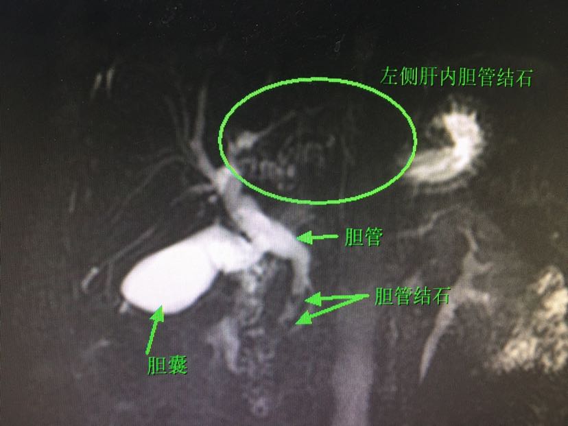 肝內膽管結石只能開大刀麼?