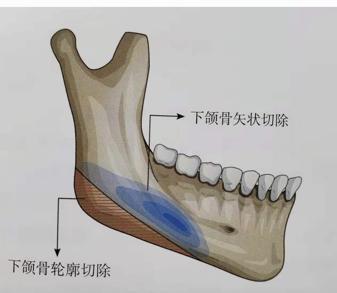 51. 由幼至老下颌骨形态的改变 (2)-颌面口腔应用解剖-医学