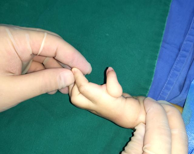 刚出生的婴儿手指是漂浮拇最佳手术时间是什么时候