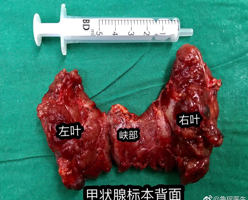 甲状腺的形态,位置和解剖结构