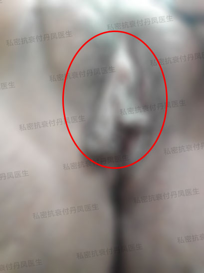 我28岁小阴唇挺大的 除了小阴唇缩小术还有其他选择吗 付丹凤主治医师 爱问医生