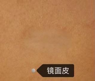 质地的改变:疤痕皮肤缺乏弹性,像镜子一样反光(镜面皮),往往也没有