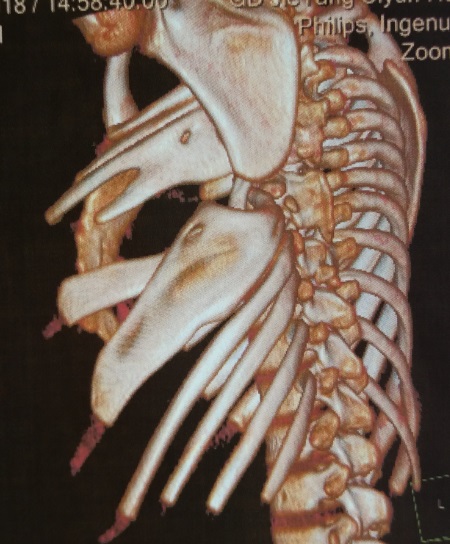 肋骨融合手术图片