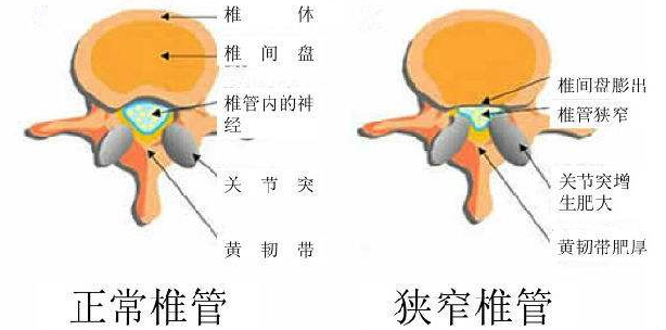 医生 腰椎管狭窄了该怎么办 医生说 39健康网