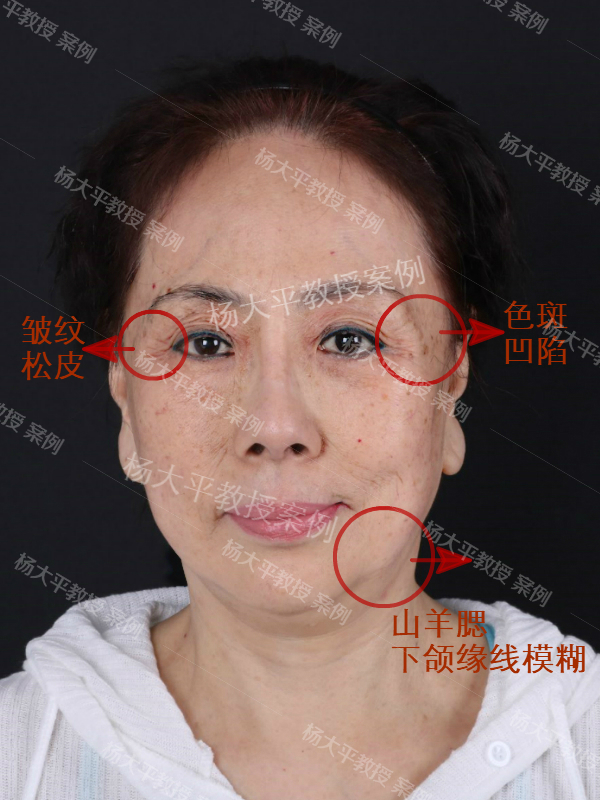 57岁老阿姨做完面部提升手术后逆龄效果令人吃惊
