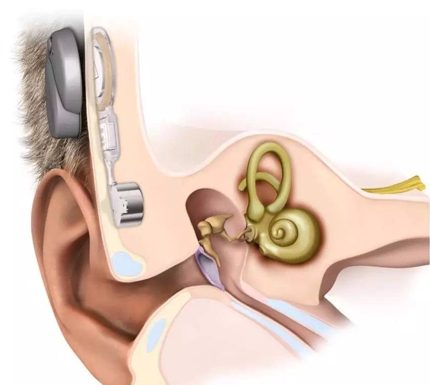 中耳植入式助聽裝置