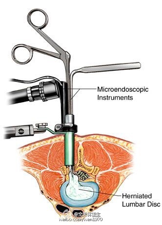 柳叶刀儿童或年轻人的腰椎间盘突出症