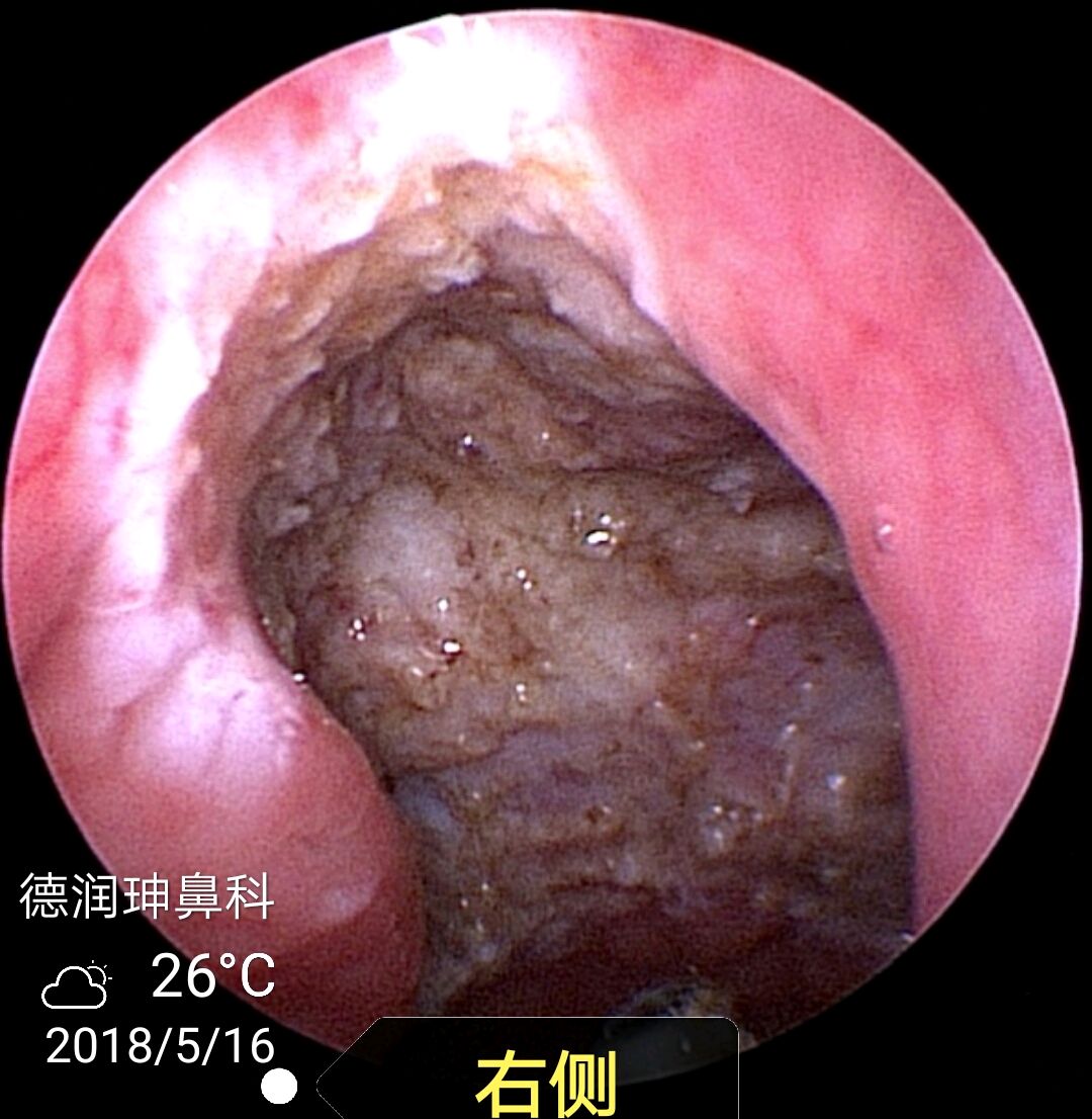 出完上午半天门诊,在为这位小公举的父亲做全组鼻窦开放术.