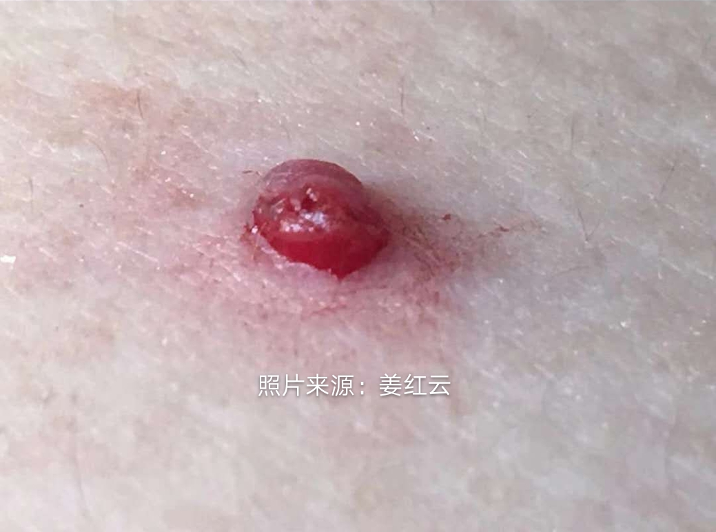 皮肤上的小血疱是啥东西?