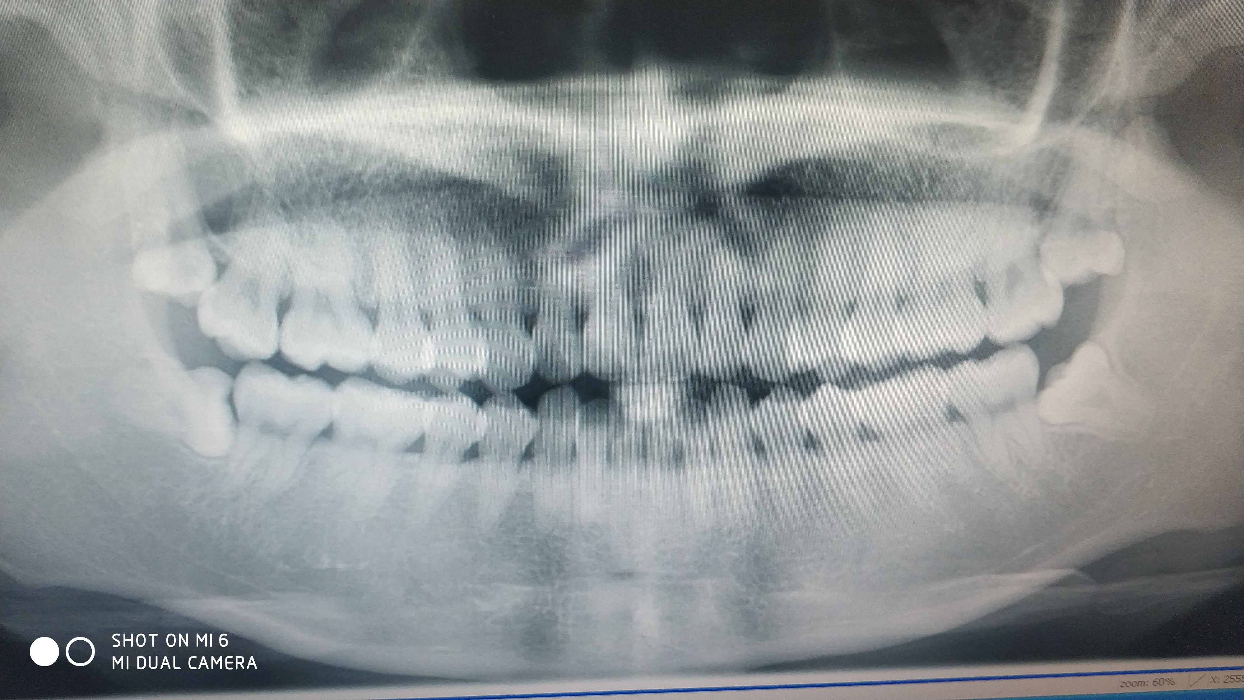 牙齿曲面断层片图片