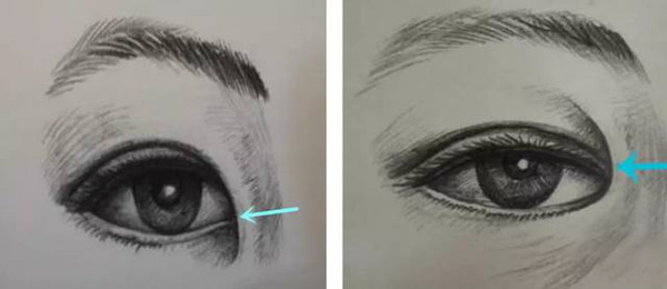 开内眼角(内眦赘皮)你知道多少?