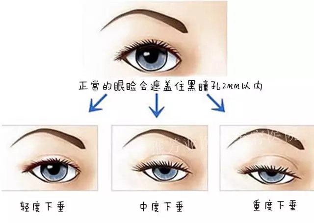 上睑下垂是种病态的功能丧失,和双眼皮手术是有区别的