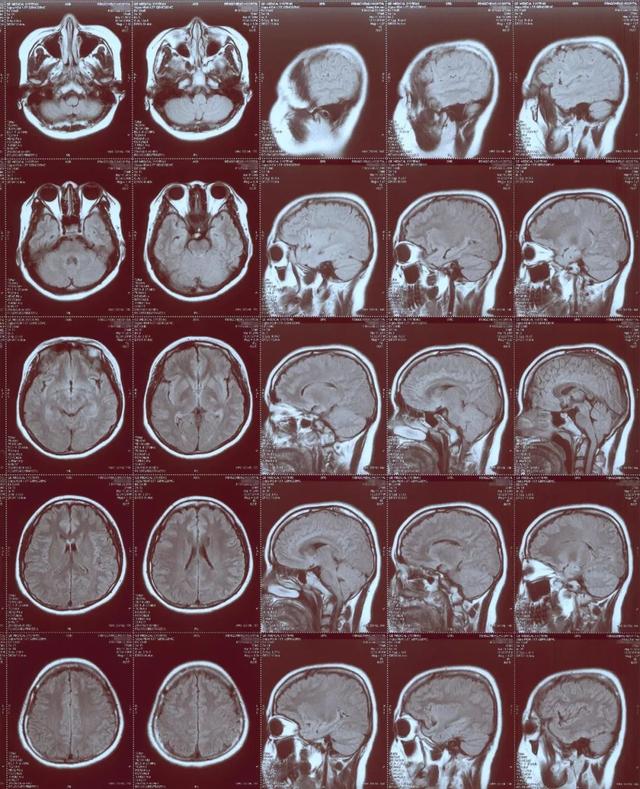 音频病例点评脊髓空洞症