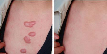 增生性疤痕是怎么回事?