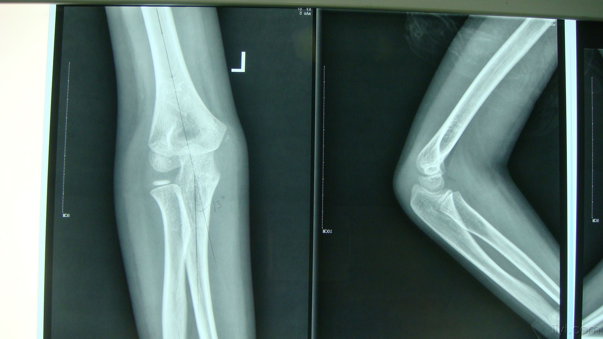 肘内翻畸形俗称为"胳膊肘往内拐",是儿童胳膊肘部骨折常见的远期后遗