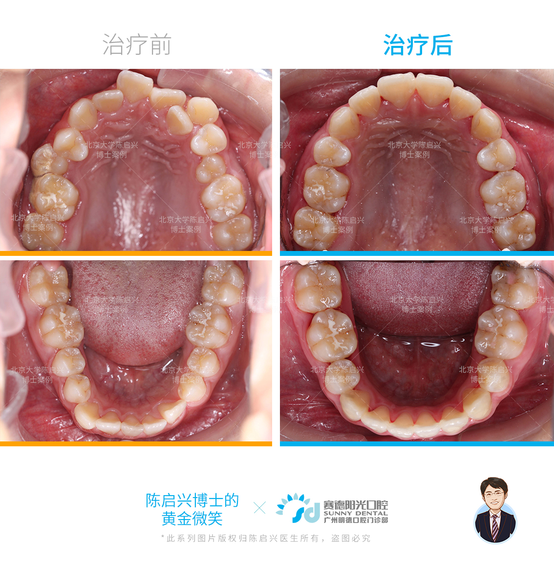 牙齿影响脸型对比照图片