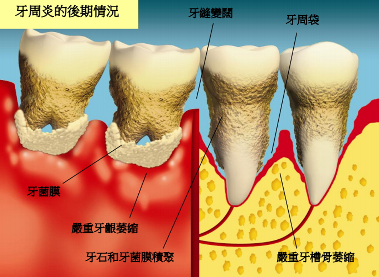 牙周炎怎么治疗好得快图片