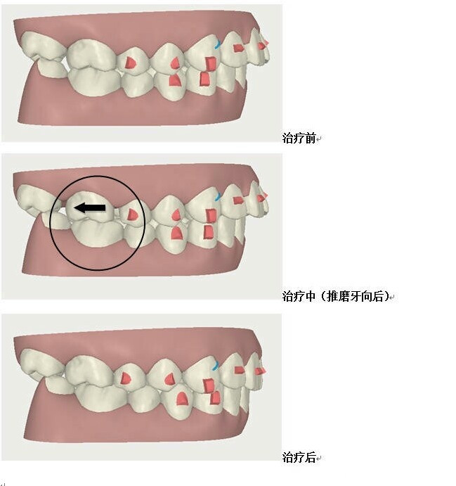 磨牙后三角区域图片