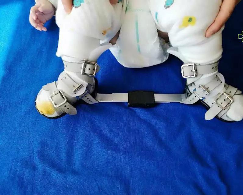 马蹄足的支具治疗之父母必知