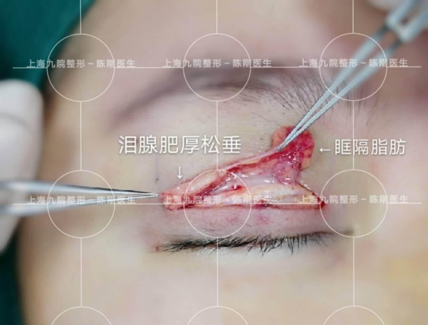 肿泡眼的主要元凶有,眶隔脂肪肥厚,roof层肥厚以及泪腺肥厚松垂.