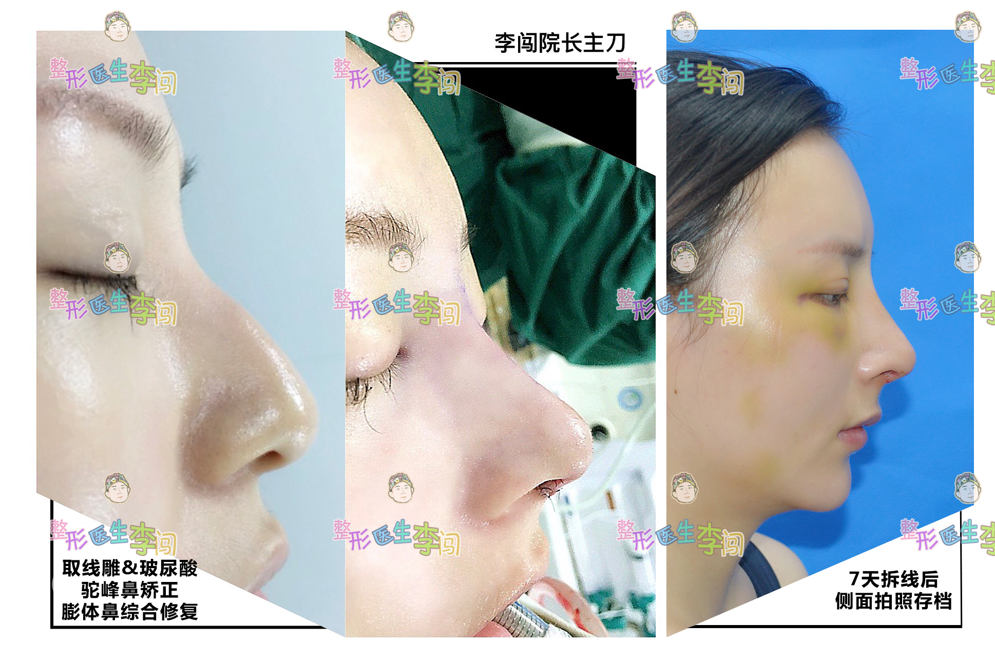 驼峰鼻矫正后你的鼻子也能变得女性秀气精致