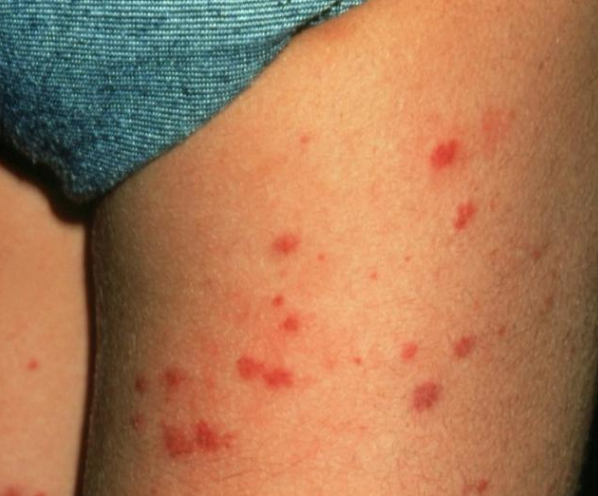 身上长了很多小红痣是什么原因?各种情况,本文为你分析