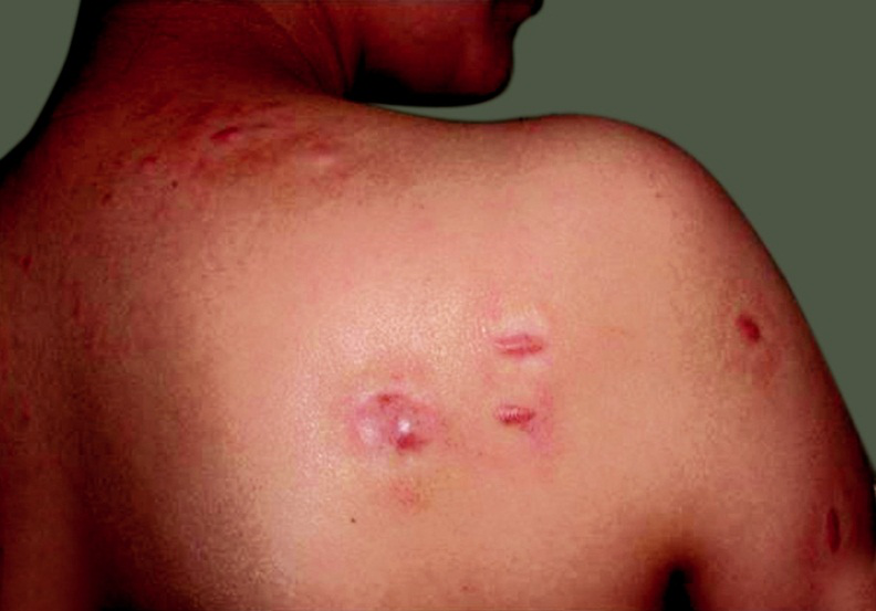 痤疮疤痕疙瘩的预防和治疗-屈新华副主任医师-爱问医生