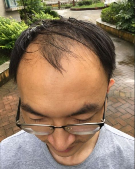 这是他秃顶的照片,许多人完全不敢相信这种大面积的秃顶也能恢复,就连