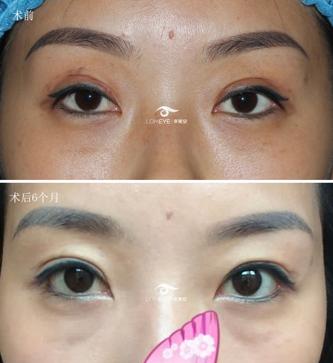 双眼皮修复技术如何改善疤痕明显