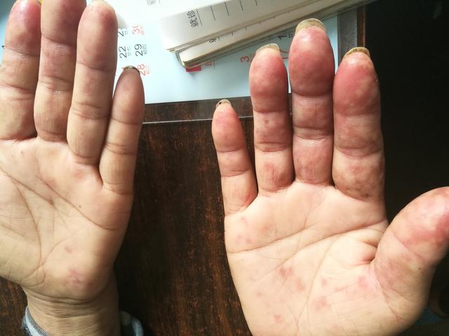 伴有发热的皮肤病(三):结缔组织病
