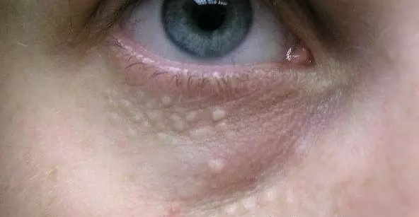 3,皮脂腺腺瘤.常常是结节性硬化症的一个表现.