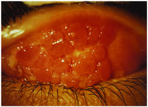 泡性结膜炎的症状图片图片