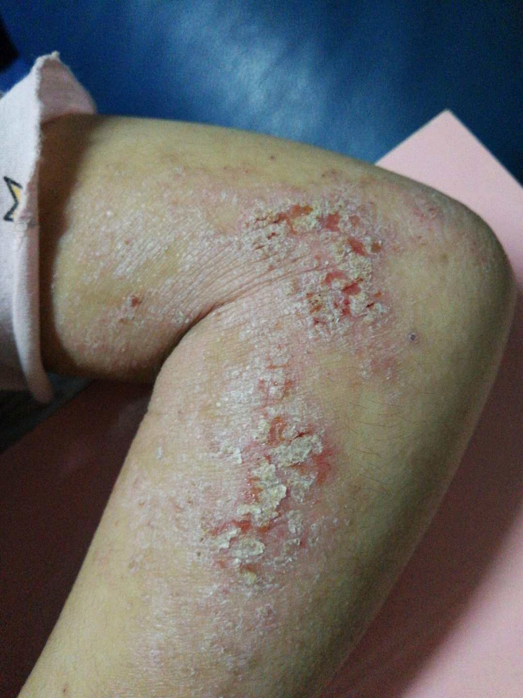 干燥脱皮瘙痒,特应性皮炎,拿什么来拯救你