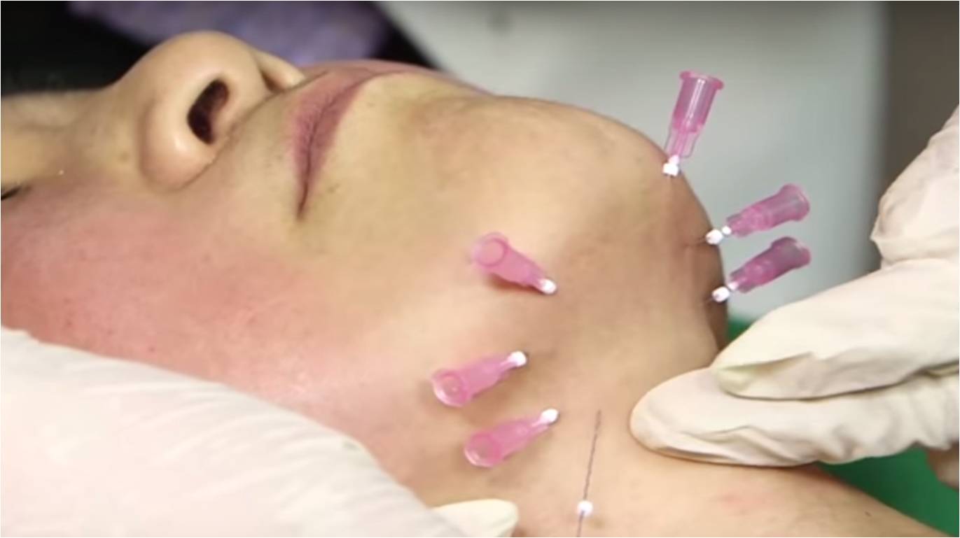 面部线雕——蛋白线在面部抗衰中的应用