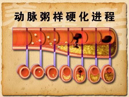 动脉粥样斑块.jpeg
