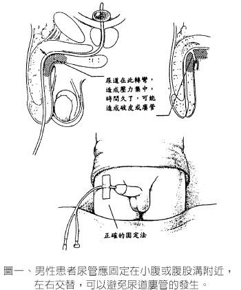 尿管怎么插拔掉图片