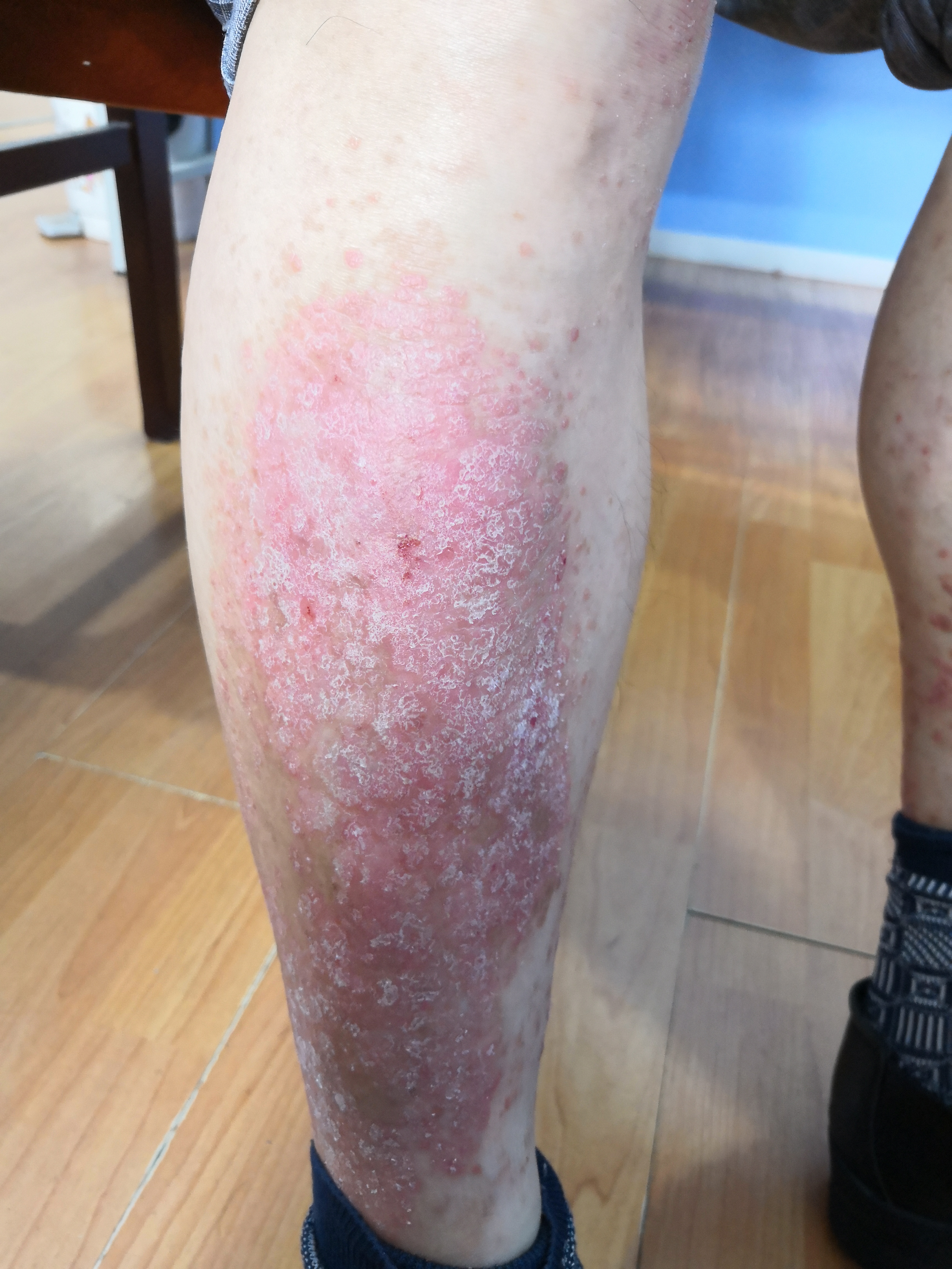 皮肤都是干燥脱屑银屑病和鱼鳞病有什么不同