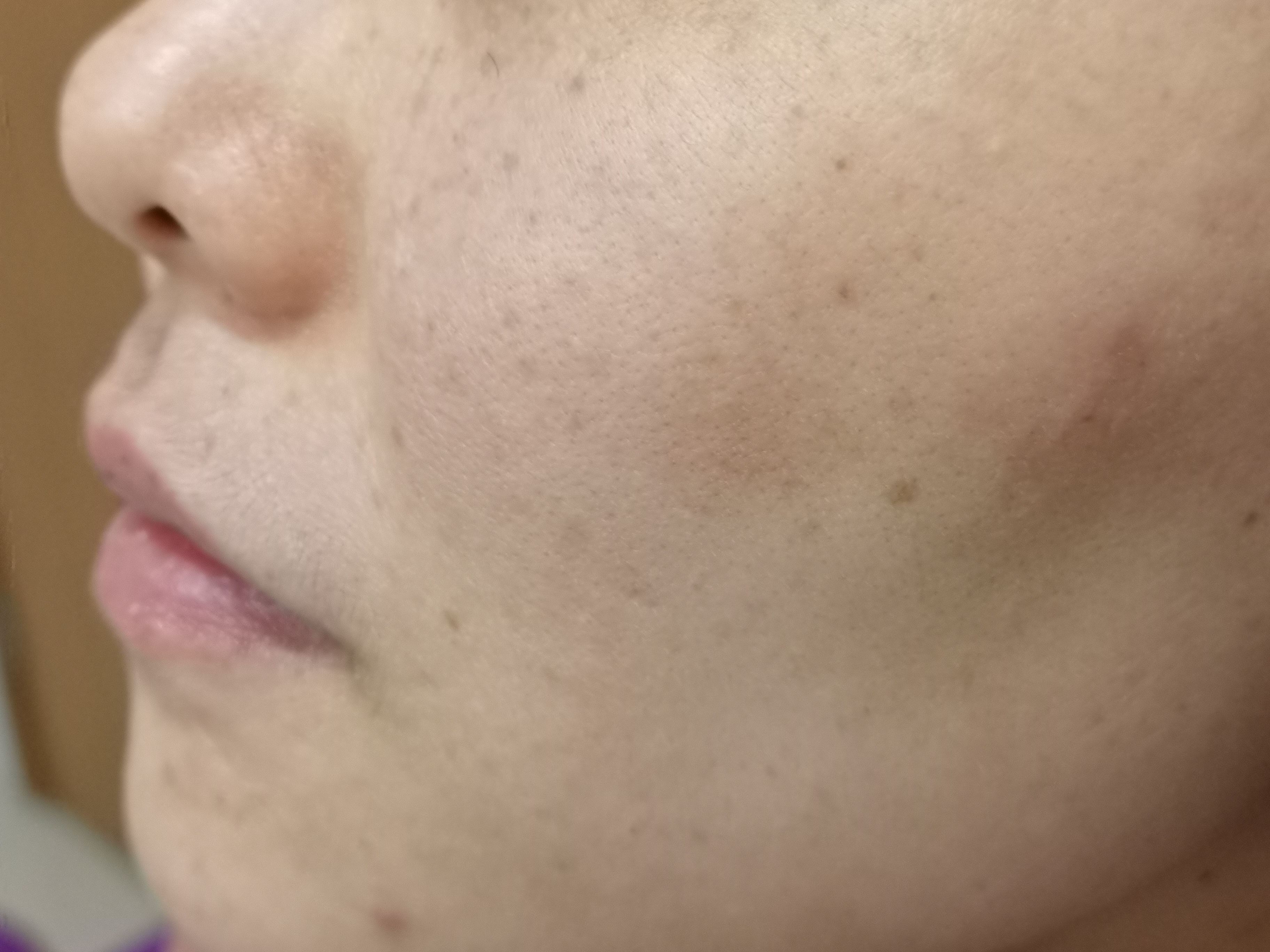 雀斑斑痣和雀斑样痣