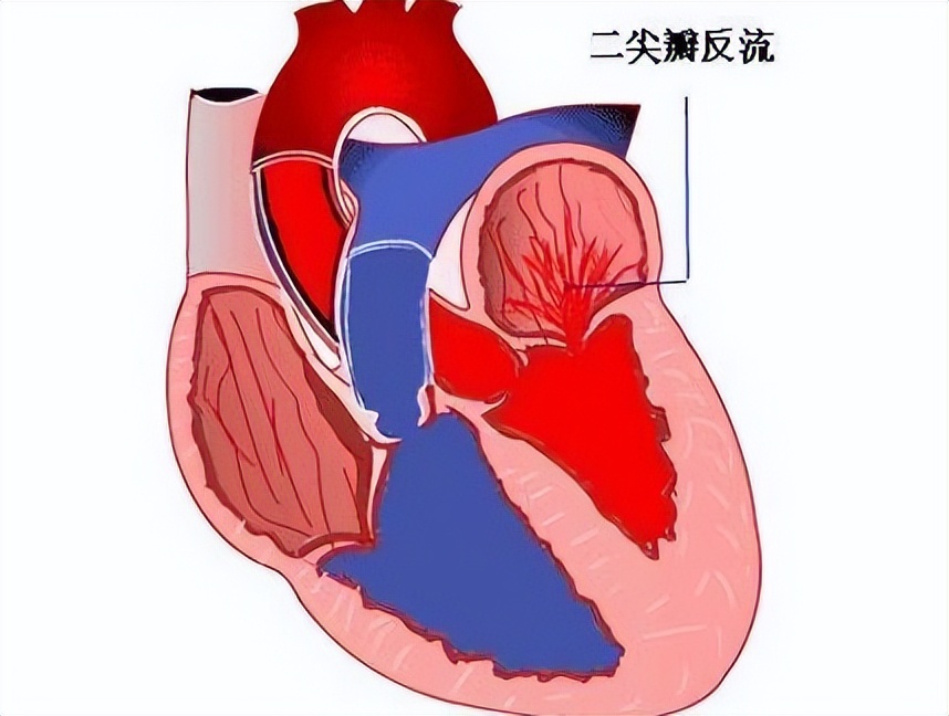 腱索斷裂,乳頭肌缺血等原因也可能會導致.