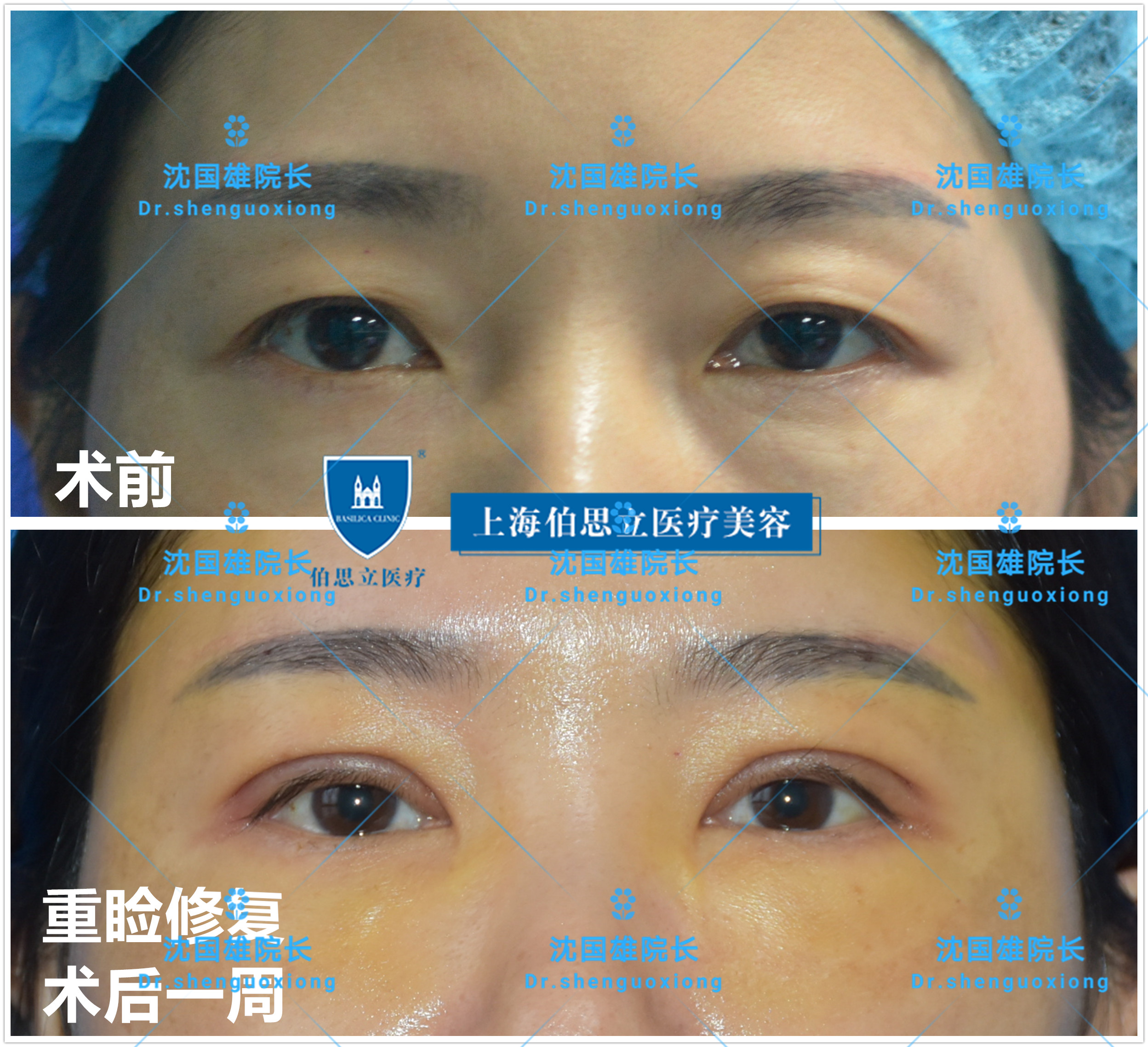 年轻女性做整容手术-蓝牛仔影像-中国原创广告影像素材