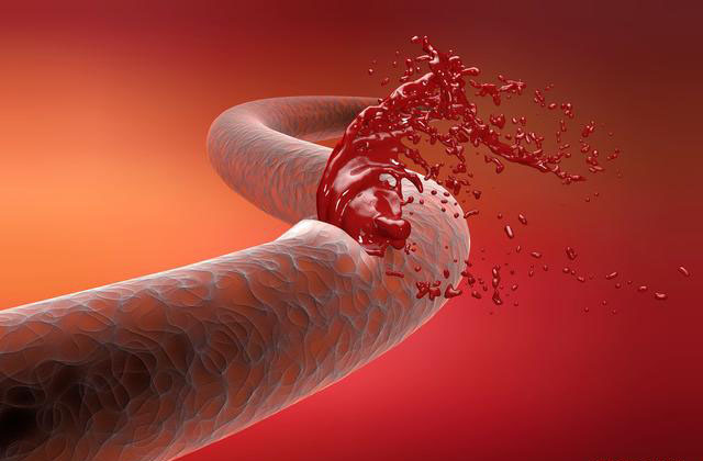 大咯血介入止血治疗后又出现肺栓塞,病人儿子问是否是介入造成的