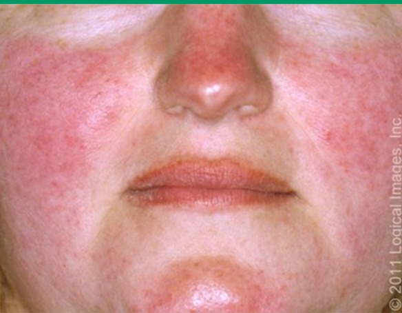 酒渣鼻的临床表现 发病机制及诱因 陈波执业医师 爱问医生