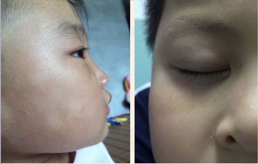 面部白色糠疹                  下眼皮内侧的皱褶