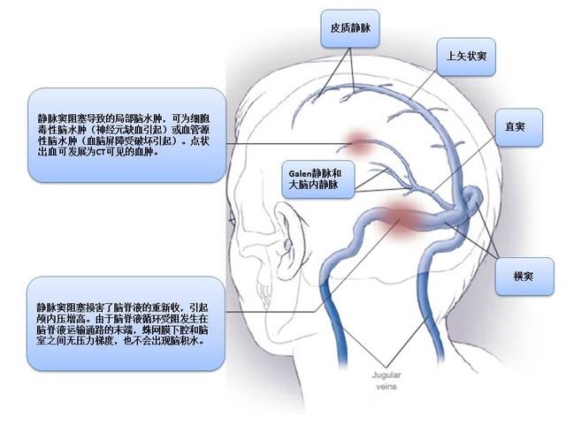 脑静脉窦血栓是神经科急症,如不及时诊断并采用抗凝治疗,将危及患者