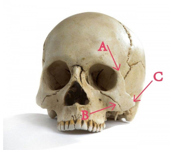 颧骨解剖图片