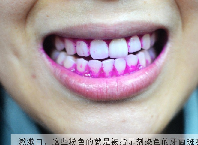 菌斑未得到及时的控制会影响口腔卫生,导致牙龈发炎,同时导致牙结石的