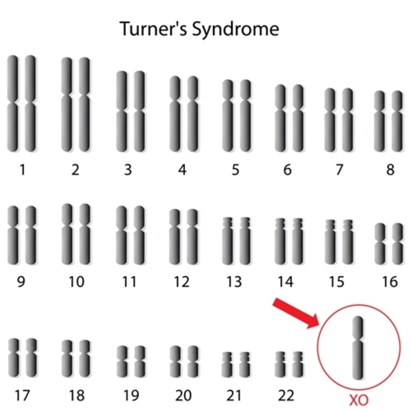 turner-syndrome-karyotype.jpeg