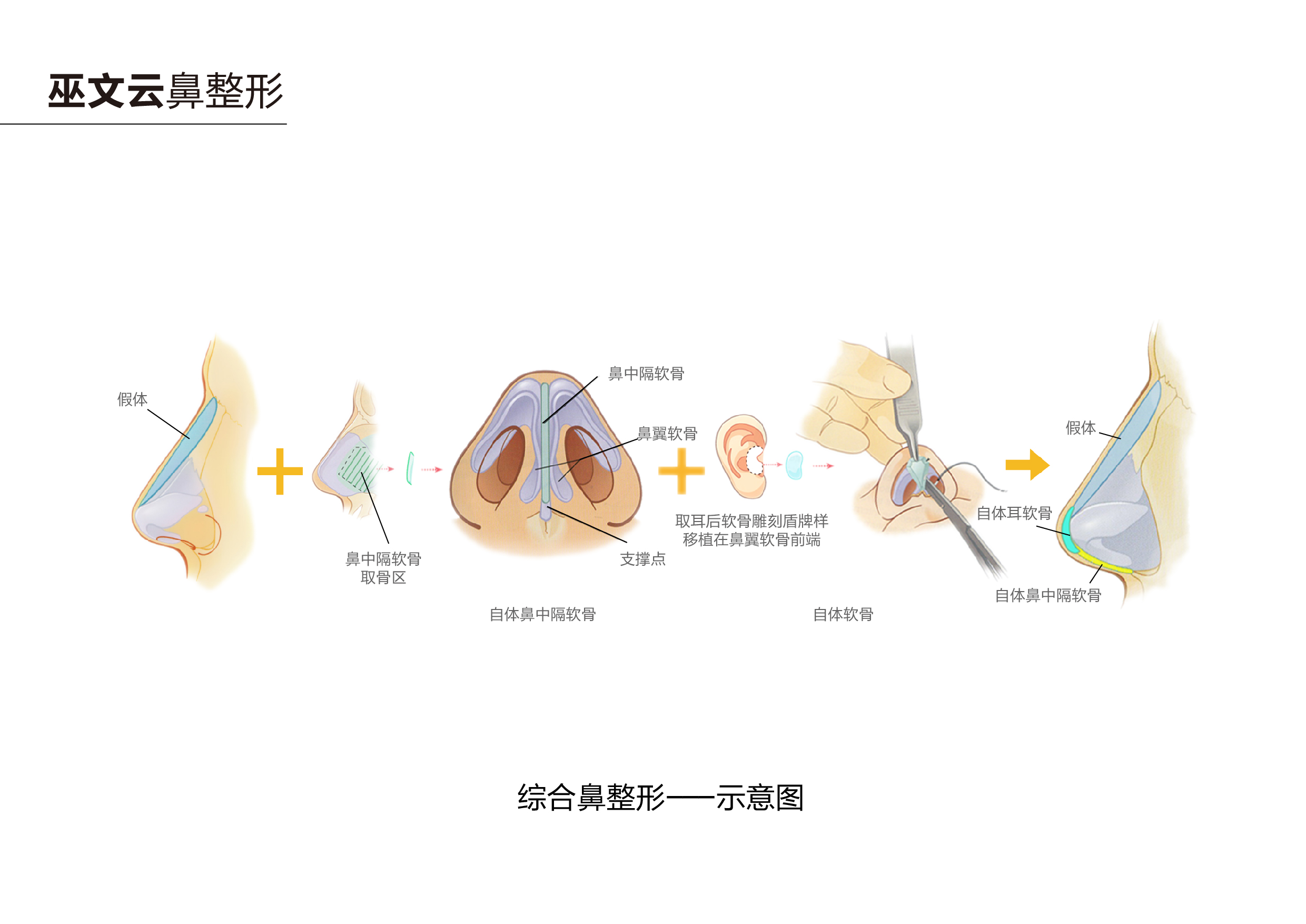 解析隆鼻技术